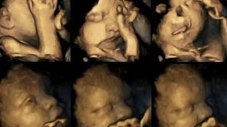 En images: un fœtus grimace lorsque sa mère allume une cigarette Foetus femme enceinte, fumer cigarette