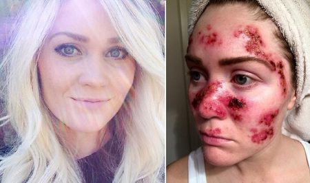 Atteinte du cancer de la peau, elle alerte sur les dangers des UV Cancer de la peau, salon bronzage
