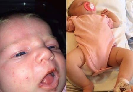herpès, bébé