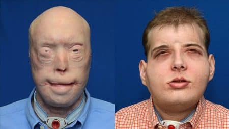 Patrick Hardison, greffe du visage, New York