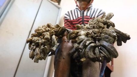 « L’homme arbre » va bientôt être opéré: une solution éphémère Abul Bajandar, homme-arbre, écorce sur les mains