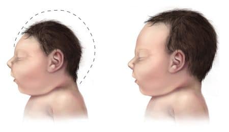 Zika: le lien entre le virus et les microcéphalies formellement établi ! Zika, microcéphalie
