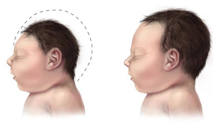 Zika: le lien entre le virus et les microcéphalies formellement établi !