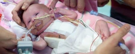Ce bébé parvient à survivre avec un cœur hors de sa poitrine