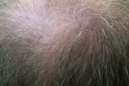 Des scientifiques japonais ont réussi à cultiver des cheveux en laboratoire